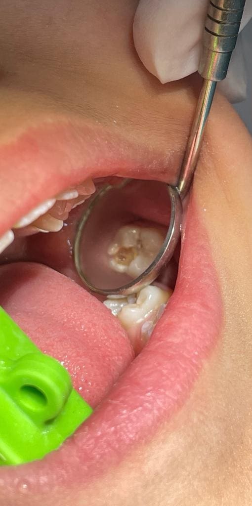 قبل وبعد علاج تسوس اسنان الأطفال