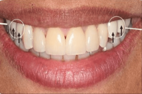 زراعة الاسنان قبل وبعد