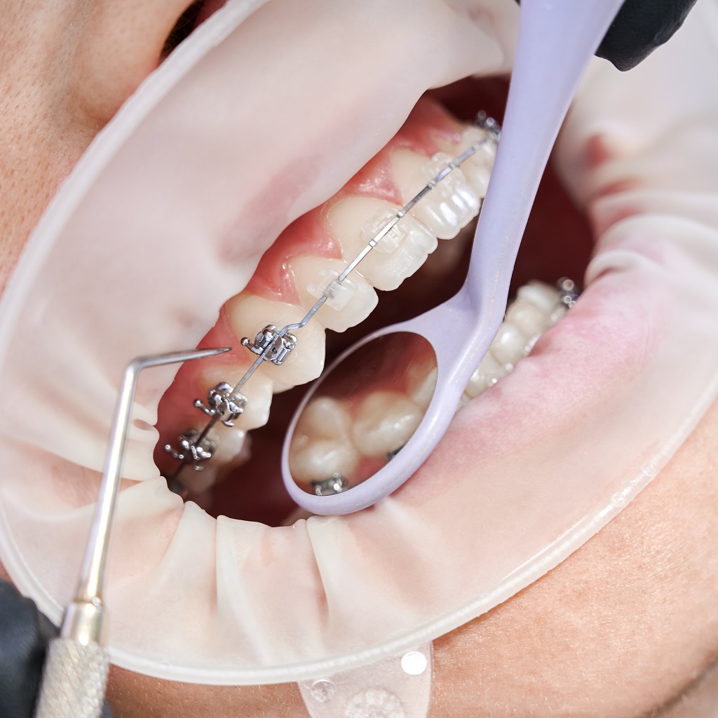 dentist-attaching-metal-braces-patient-teeth-4