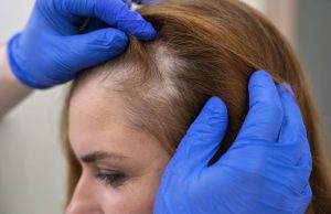 زراعة الشعر