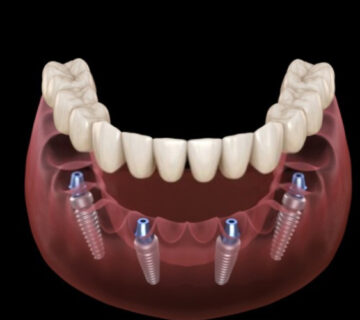 تركيب الأسنان