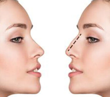 جراحة تجميل الأنف