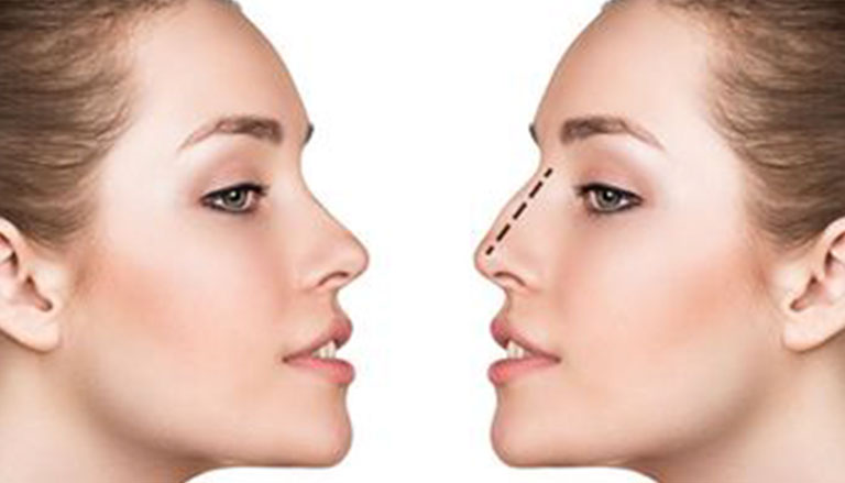 جراحة تجميل الأنف