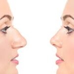 جراحة تجميل الأنف