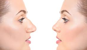 جراحة تجميل الأنف