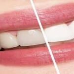 تركيبات ايماكس