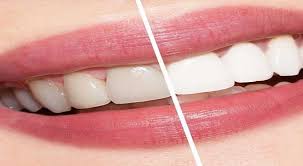 تركيبات ايماكس