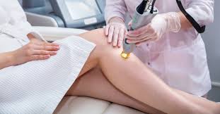 ليزر ازالة الشعر