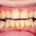 جير الأسنان