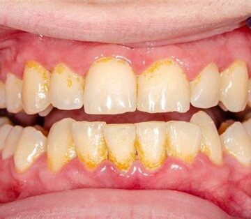 جير الأسنان