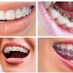 تقويم الأسنان