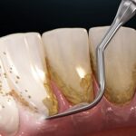 افضل عيادة تنظيف أسنان في جدة