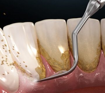 افضل عيادة تنظيف أسنان في جدة