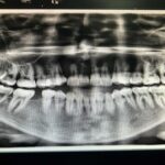 أشعة الأسنان