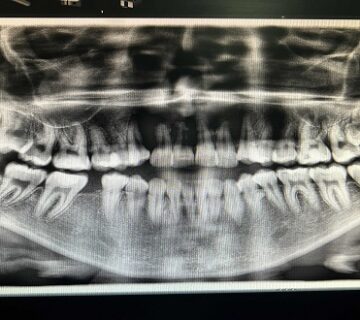 أشعة الأسنان