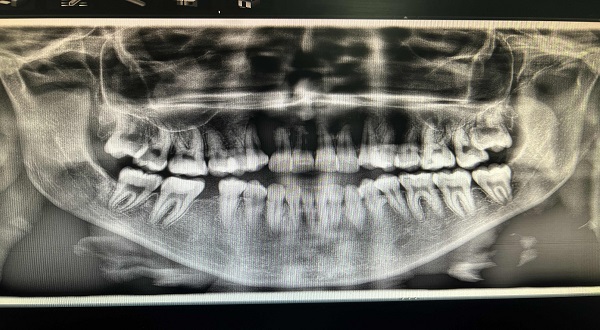أشعة الأسنان