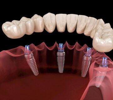 زراعة الأسنان