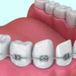 أنواع التقويم للاسنان