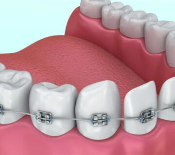 أنواع التقويم للاسنان