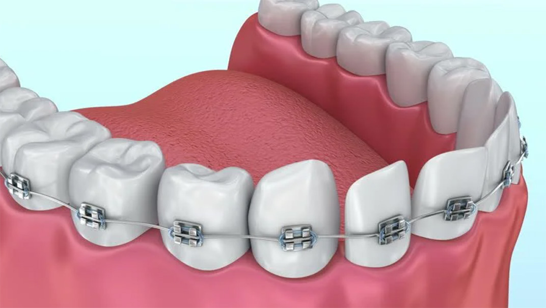 أنواع التقويم للاسنان