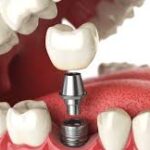 زراعة الأسنان