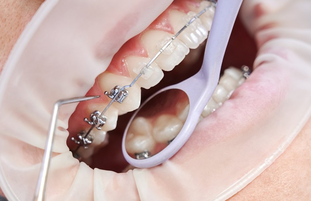 Close up of orthodontist using cofferdam and dental instruments while placing orthodontic brackets on patient teeth. Concept of stomatology, dentistry and orthodontic treatment.